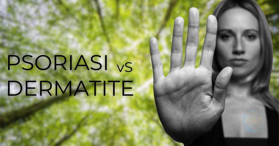 differenza tra psoriasi e dermatite