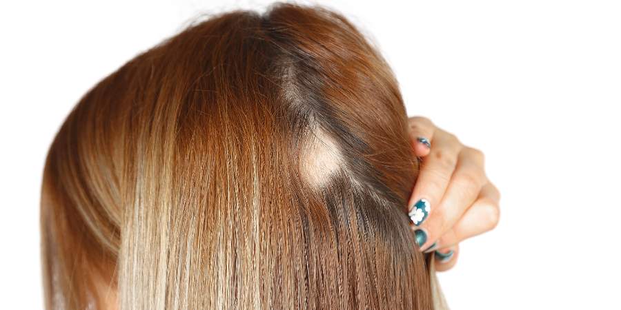 Alopecia Androgenetica: Cause, Sintomi e Trattamenti