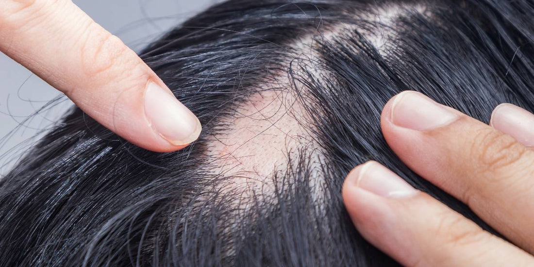 Alopecia areata: cause e trattamenti efficaci